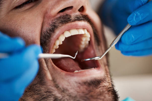 Best Emergency Wisdom Teeth Removal in Country Walk, FL
